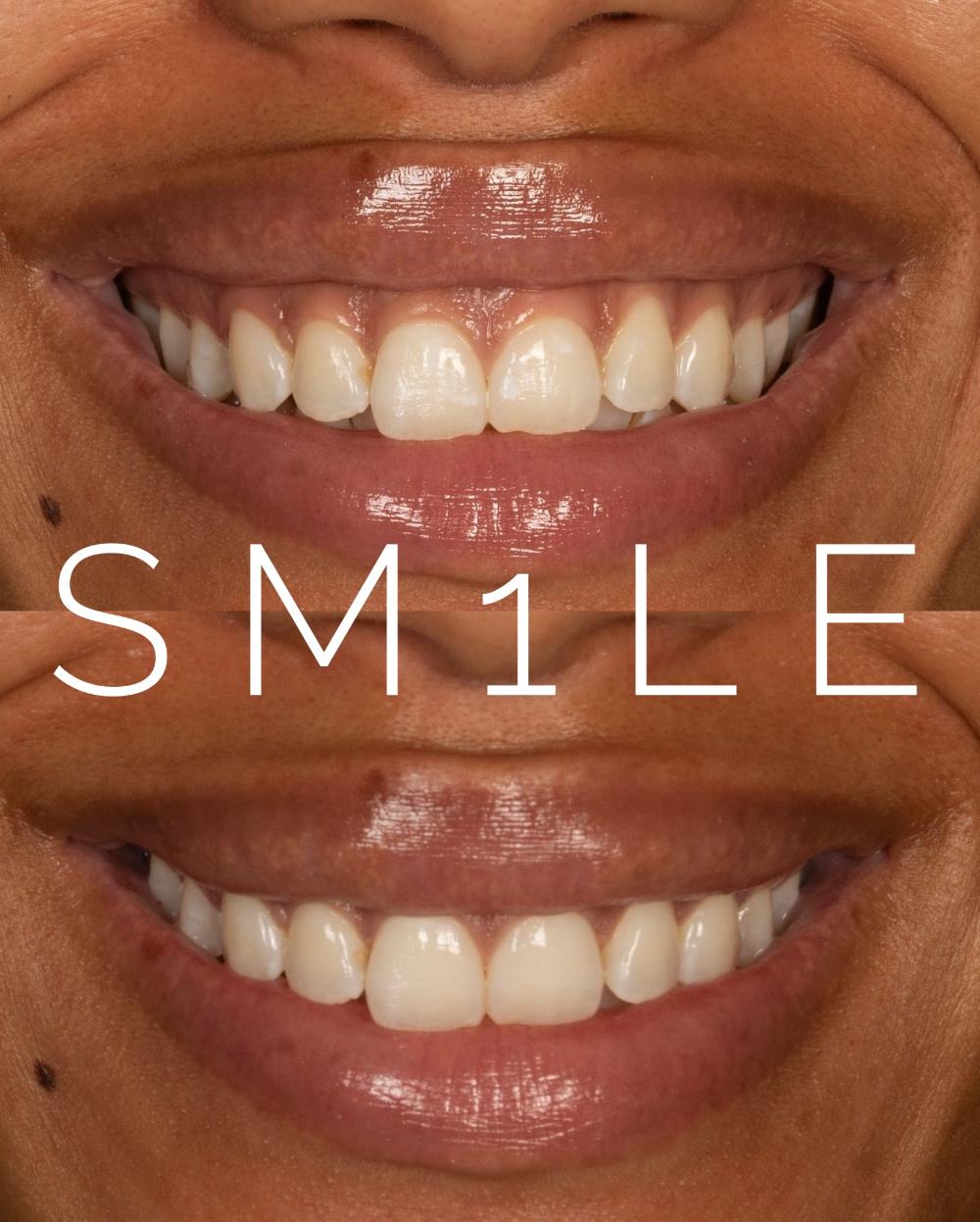 1Smile Dental | Dentures, Braces and Juvederm  