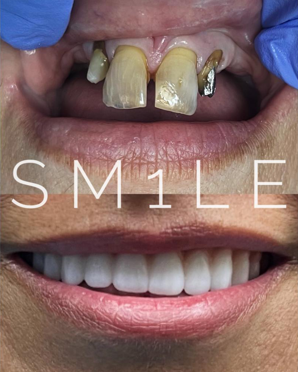 1Smile Dental | TMJ Disorders, Sinus Lift and Prosthodontist