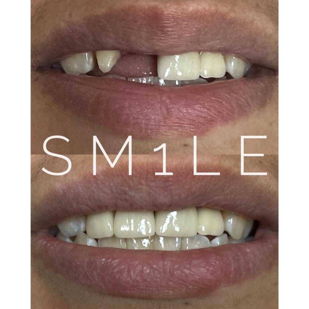 1Smile Dental | Night Guards, All-on-6 reg  and Snoring Appliances