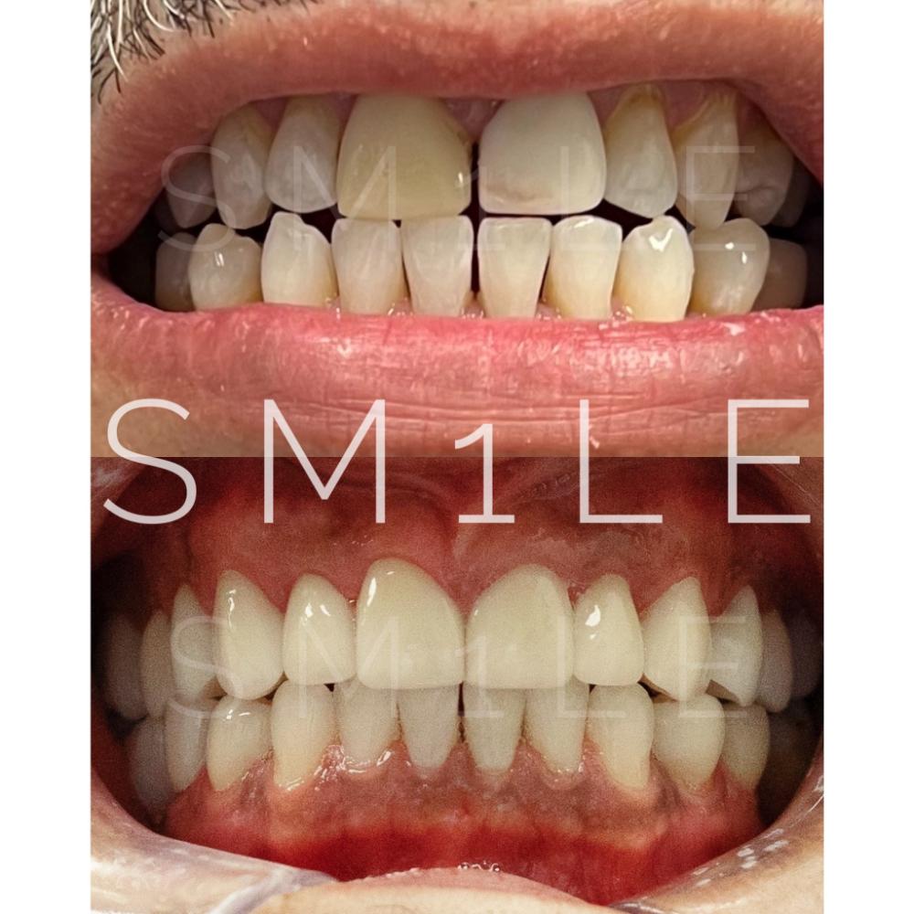 1Smile Dental | Dentures, Digital Radiography and Botox  