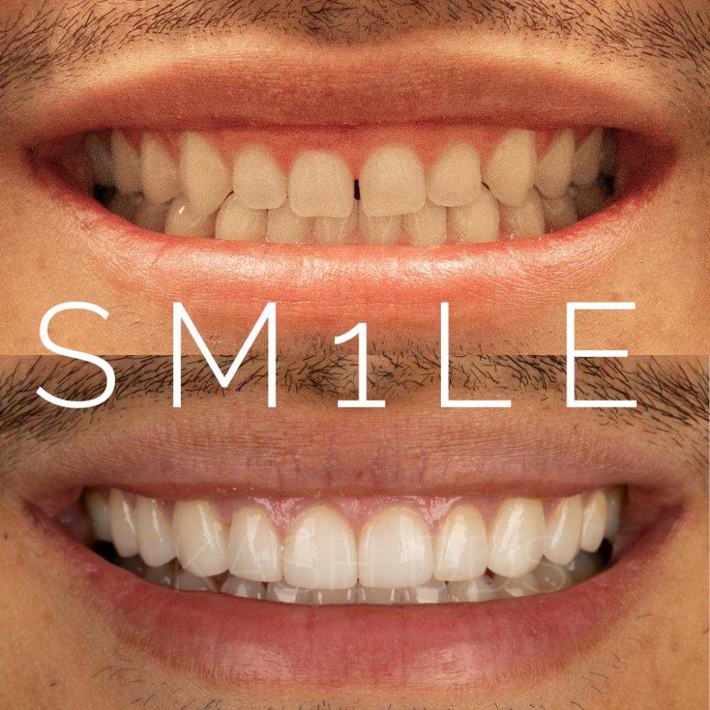1Smile Dental | Teeth Whitening, Sedation Dentistry and Night Guards