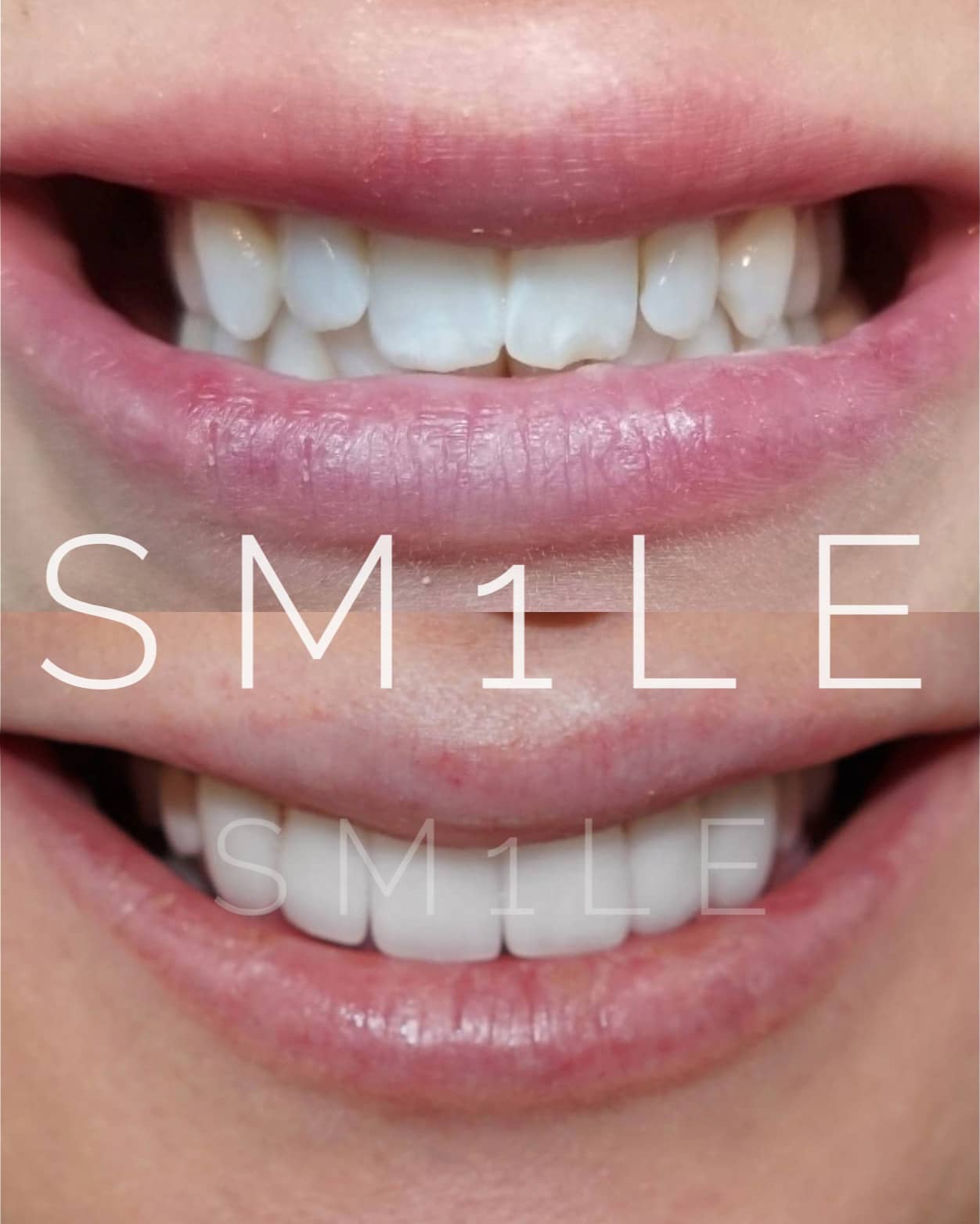 1Smile Dental | Digital Radiography, Extractions and Teeth Whitening