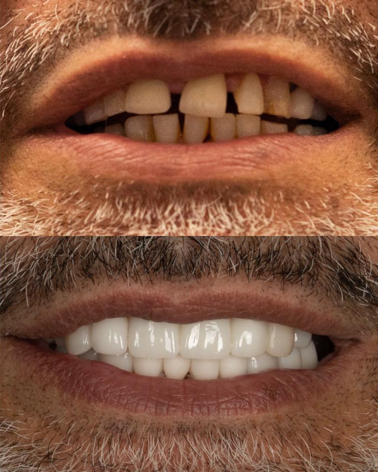 1Smile Dental | Juvederm  , Sports Mouthguards and All-on-6 reg 