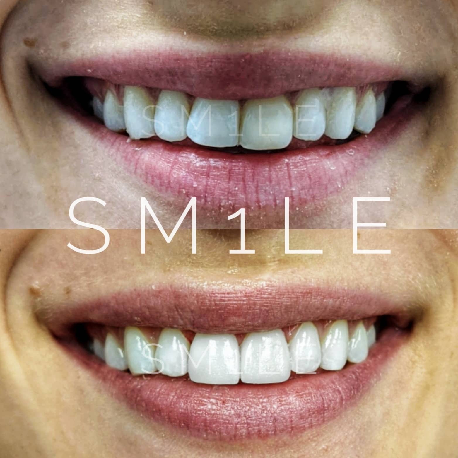 1Smile Dental | Veneers, TMJ Disorders and Juvederm®
