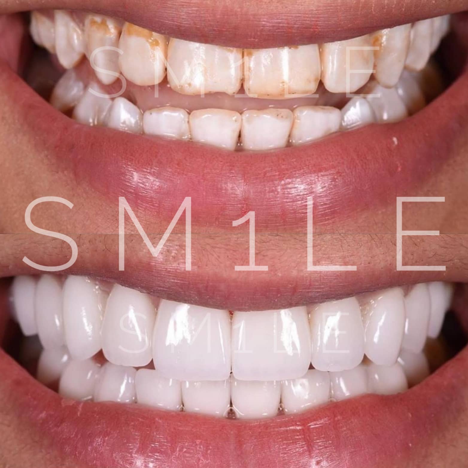 1Smile Dental | Night Guards, Botox® and Oral Cancer Screening