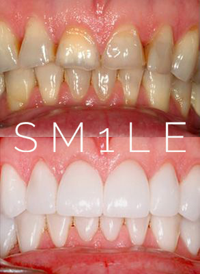 1Smile Dental | Emergency Treatment, VELscope   Cancer Screening and All-on-6