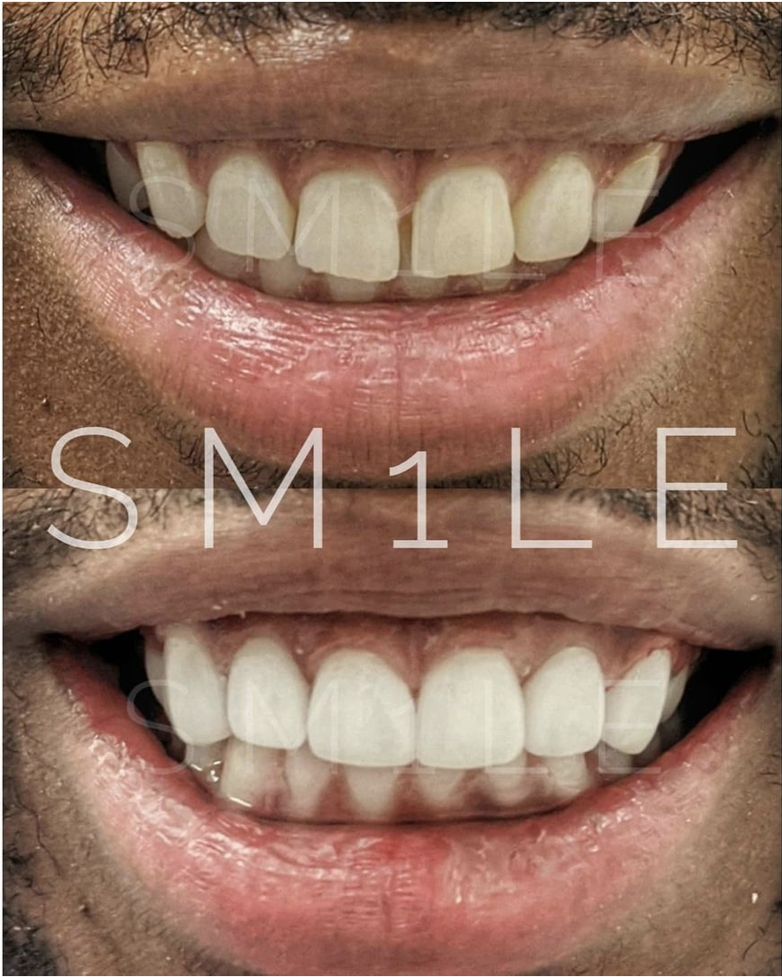 1Smile Dental | Sleep Apnea, TMJ Disorders and Root Canals