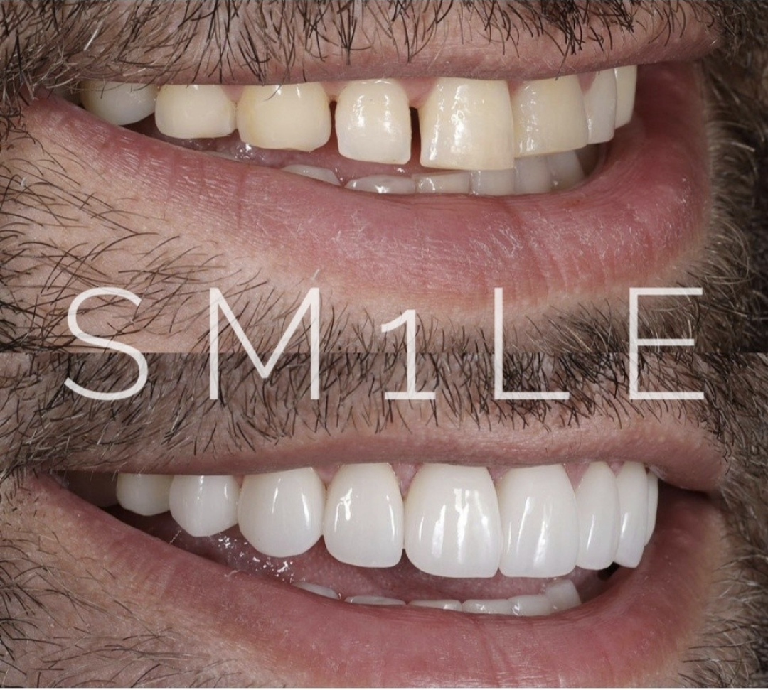 1Smile Dental | Braces, Extractions and Teeth Whitening