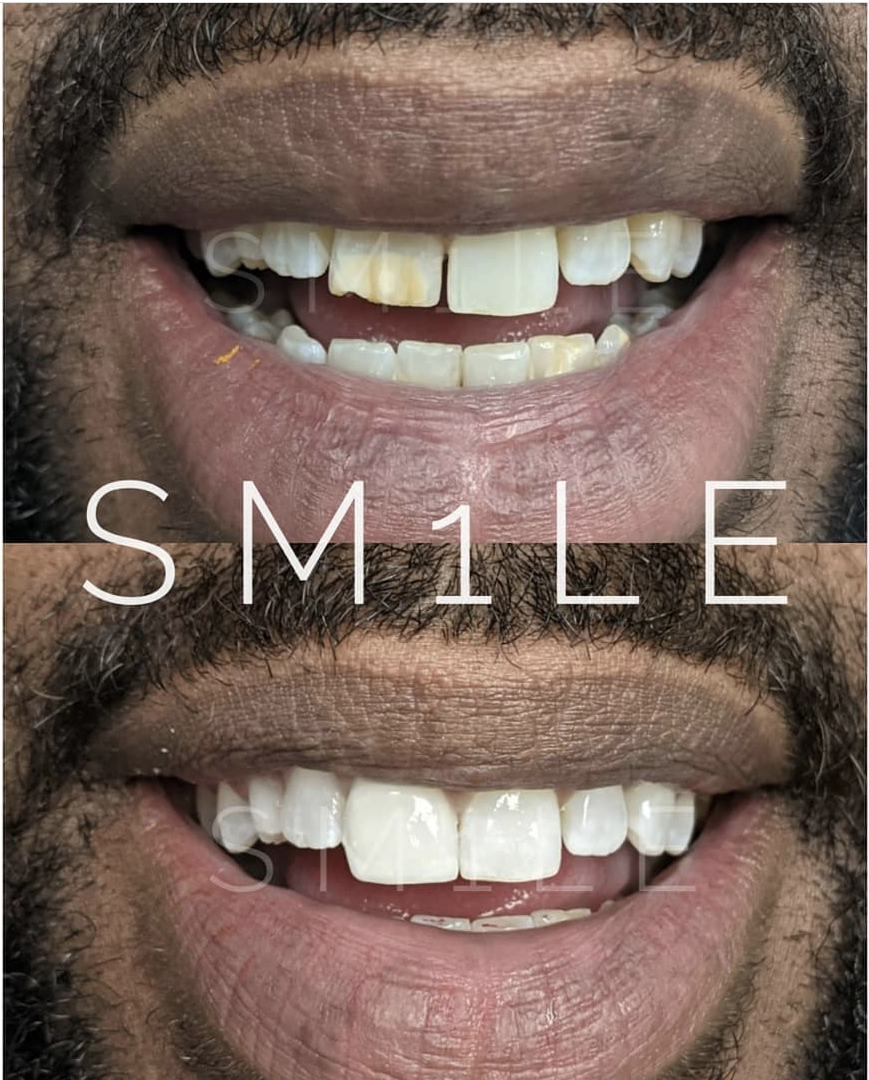 1Smile Dental | Invisalign®, Teeth Whitening and Periodontal Treatment
