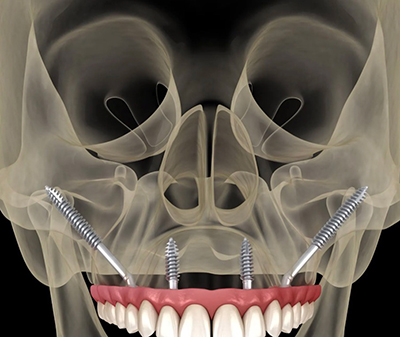 1Smile Dental | Snoring Appliances, Emergency Treatment and Veneers