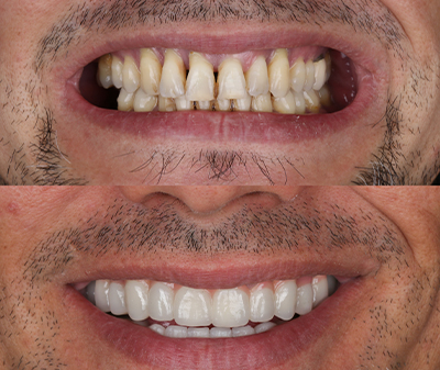 1Smile Dental | Teeth Whitening, Ceramic Crowns and Botox  