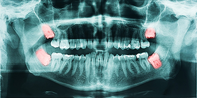 1Smile Dental | All-on-6 reg , Sleep Apnea and Wisdom Teeth Removal