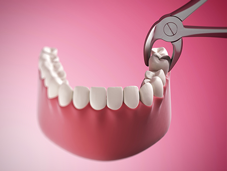 1Smile Dental | All-on-4 reg , Root Canals and Periodontal Treatment